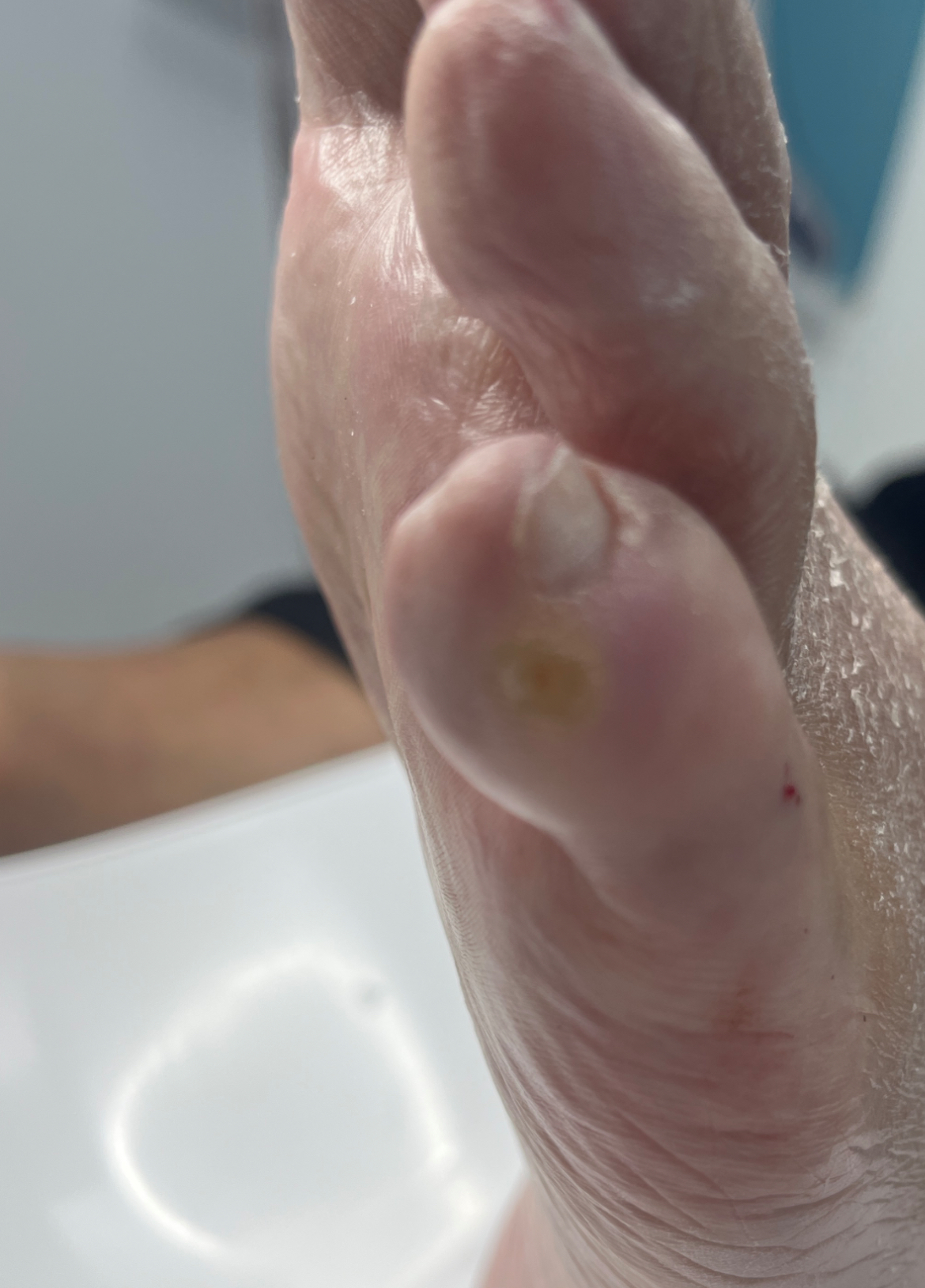 Dermal Filler for a painful and stubborn corn